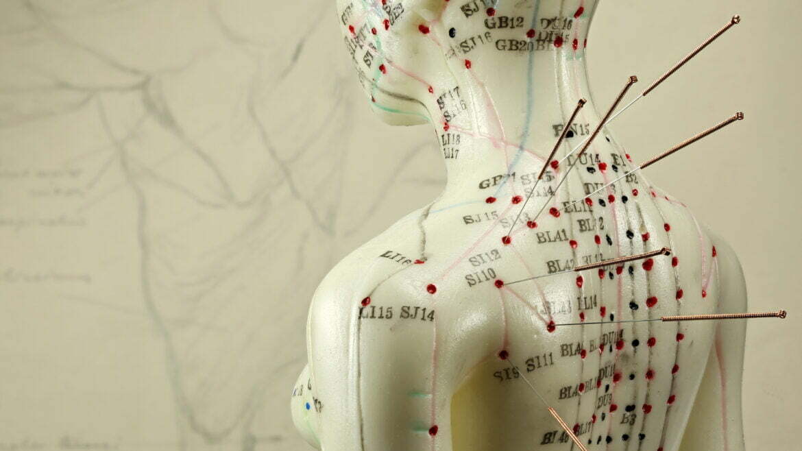 Acupuncture